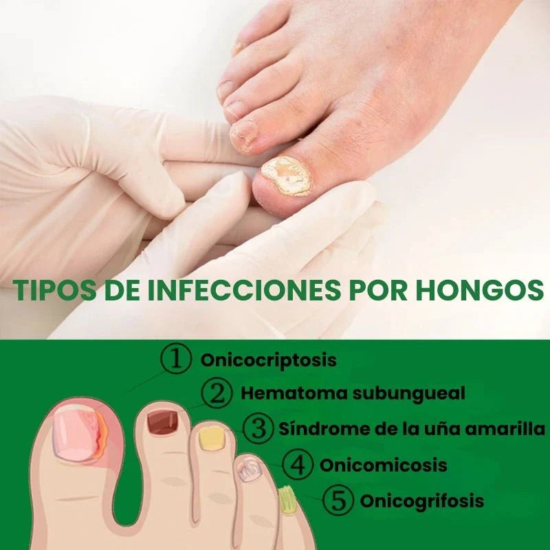 7 Days Fungus Free Nails® - Protege y elimina el hongo de tus Uñas