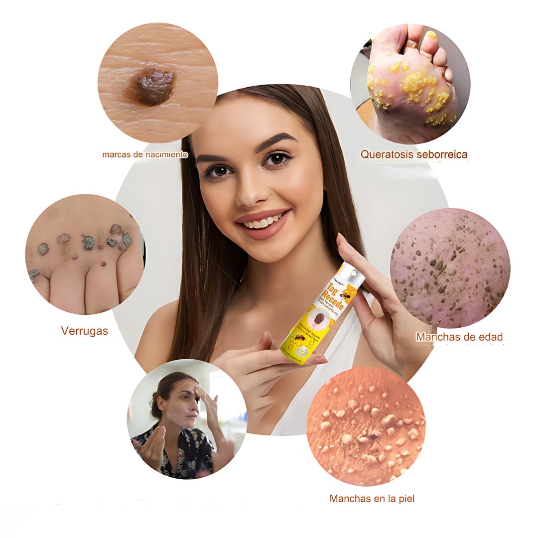 Crema Para Eliminar Verrugas